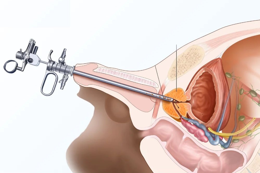Prostate Treatments