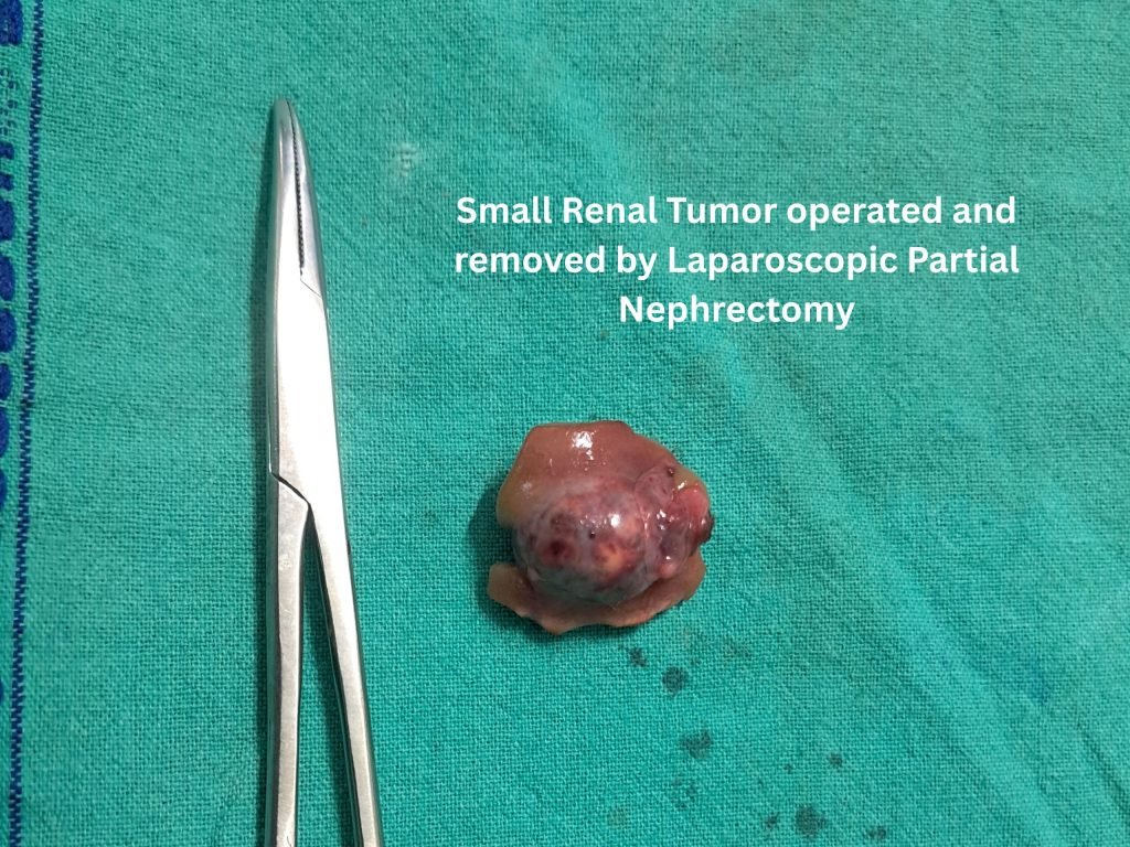 Small Renal Tumor operated and removed by Laparoscopic Partial Nephrectomy