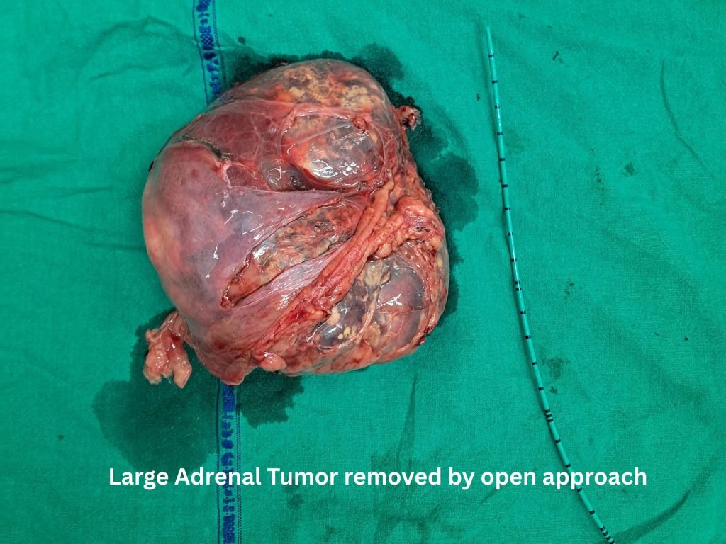 Large Adrenal Tumor removed by open approach