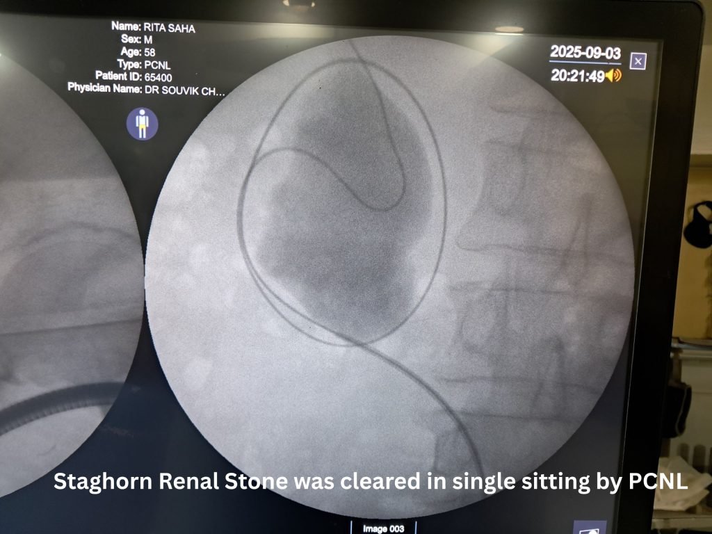 Staghorn Renal Stone was cleared in single sitting by PCNL