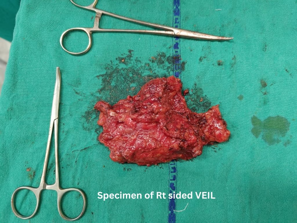 Specimen of Rt sided VEIL