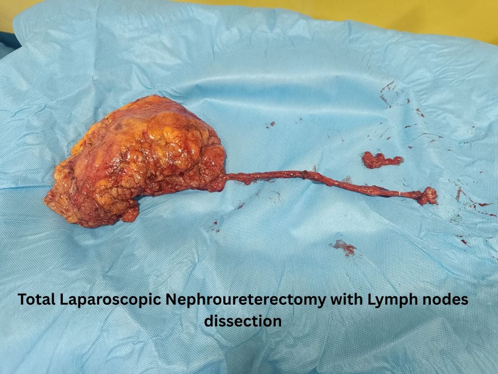 Total Laparoscopic Nephroureterectomy with Lymph nodes dissection