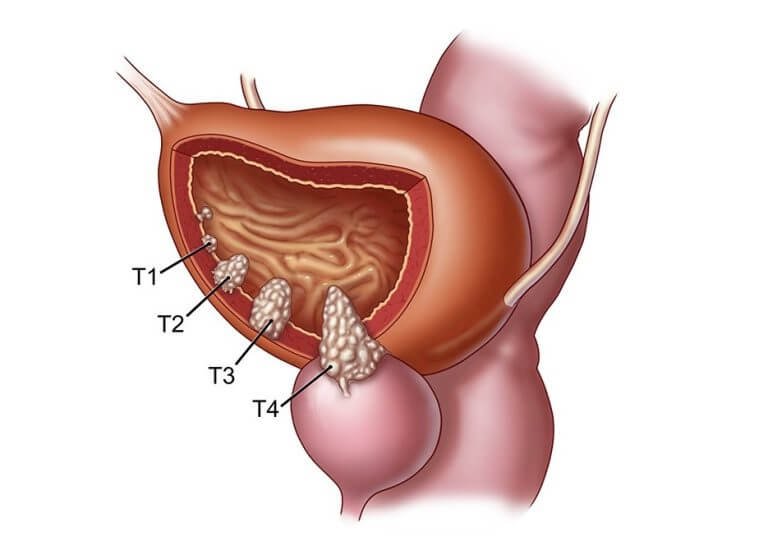 Oncological Surgeries